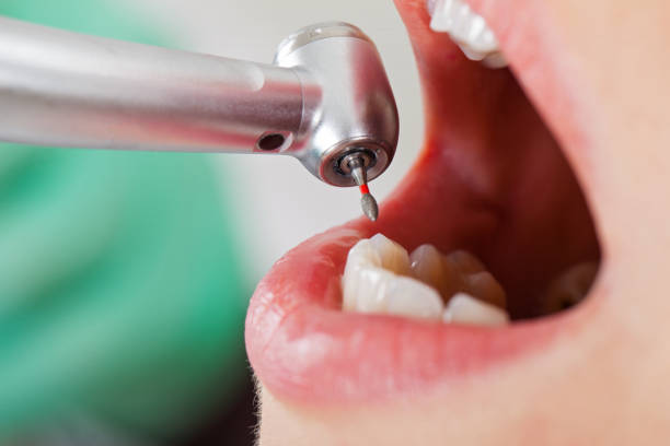 Best Emergency Tooth Extraction in Sterling City, TX